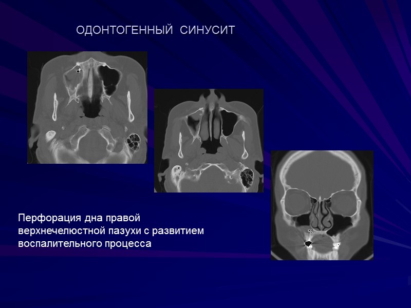 Перфорация дна правой верхнечелюстной пазухи с развитием воспалительного процесса ОДОНТОГЕННЫЙ  СИНУСИТ